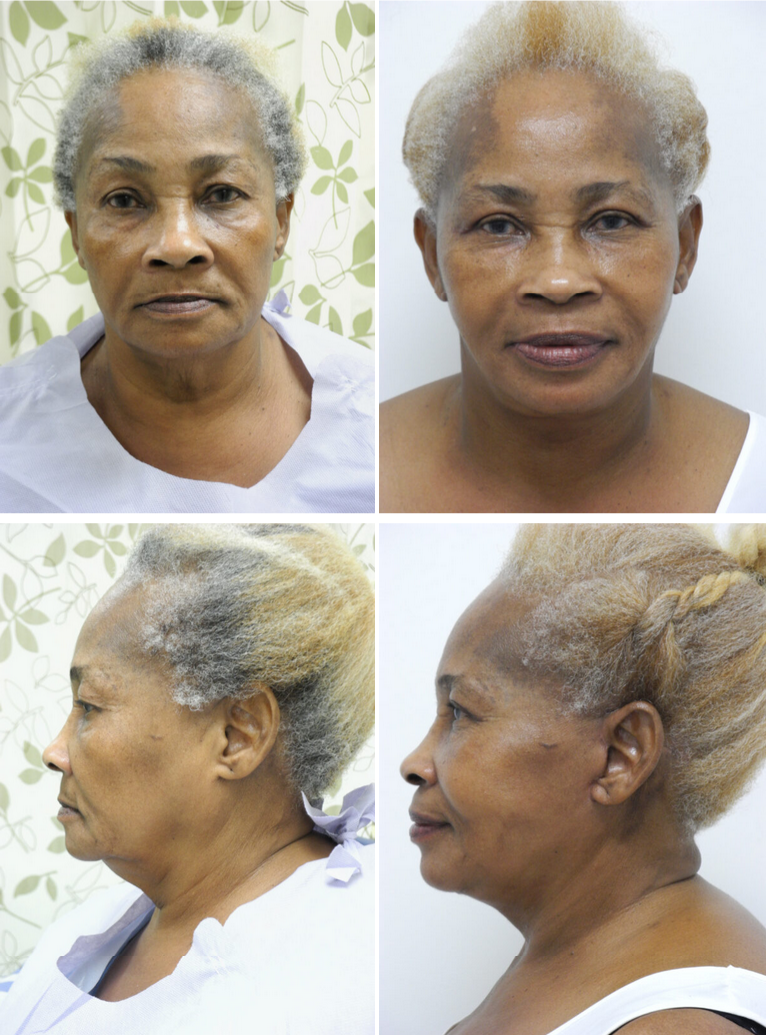 Before and After Image: Facelift Surgery - other