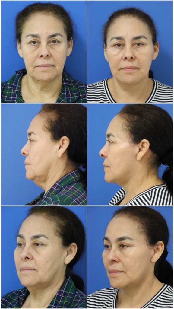 Before and After Image: Facelift Surgery - other