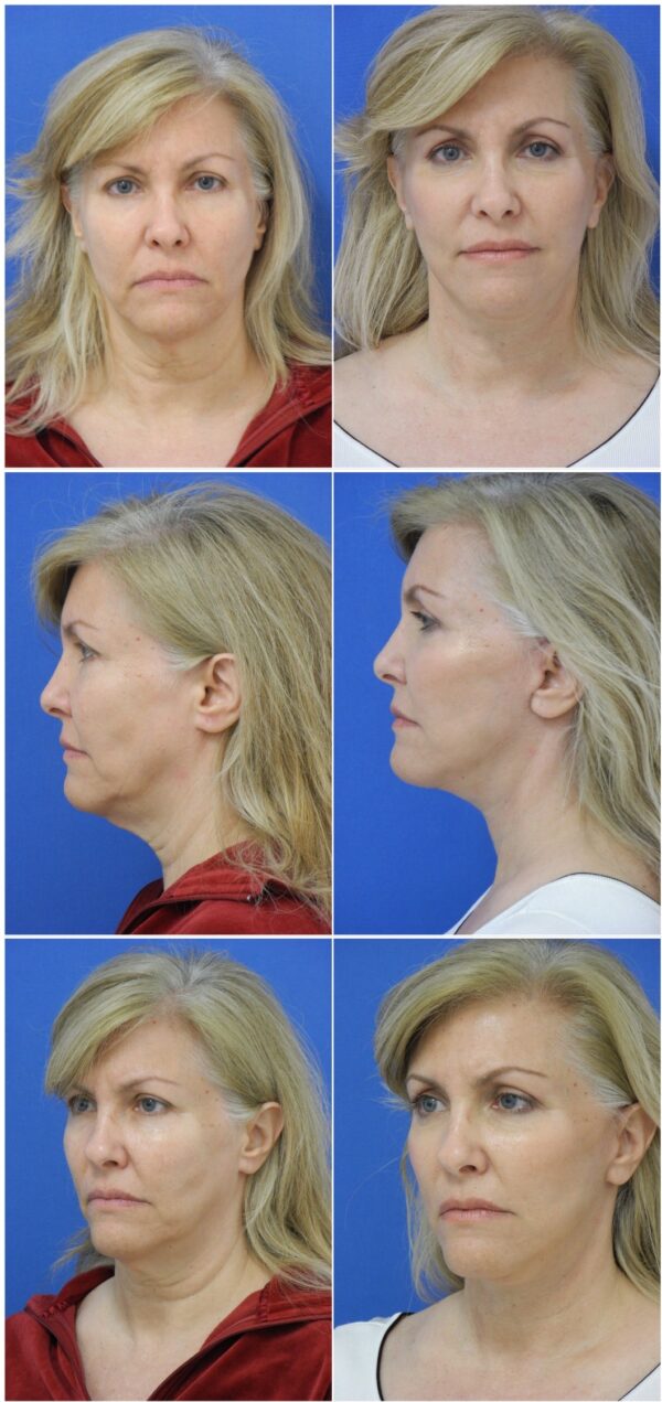 Before and After Image: Facelift Surgery - other