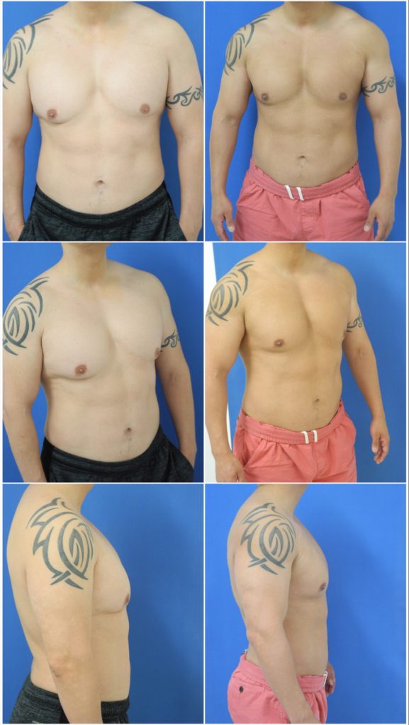 Before and After Image: Gynecomastia Correction - other