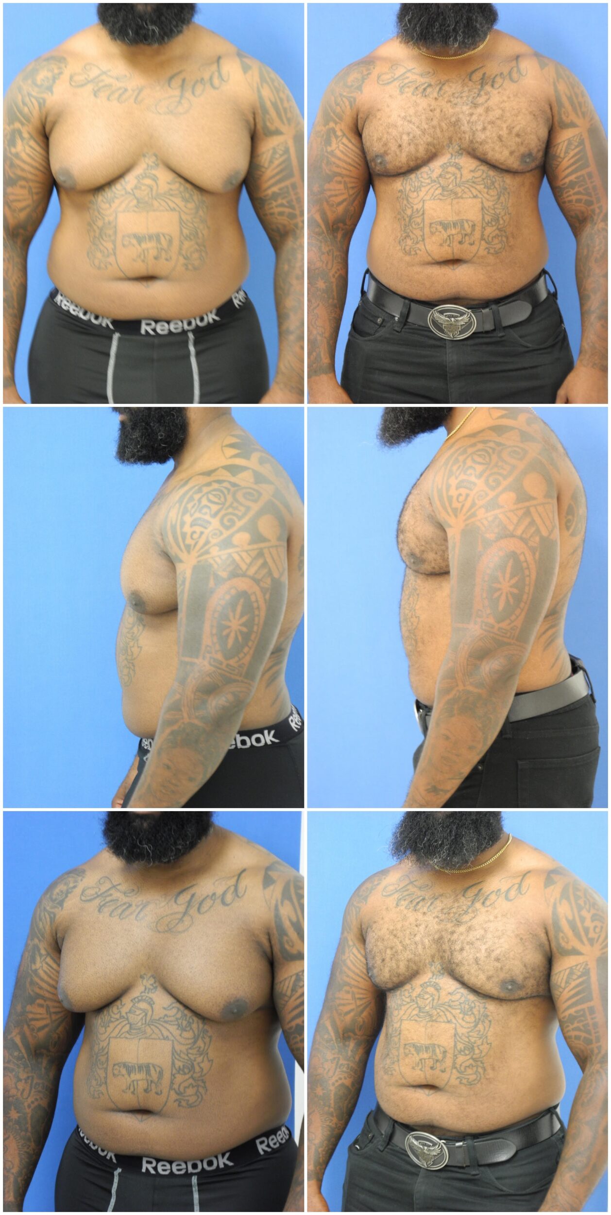 Before and After Image: Gynecomastia Correction - other