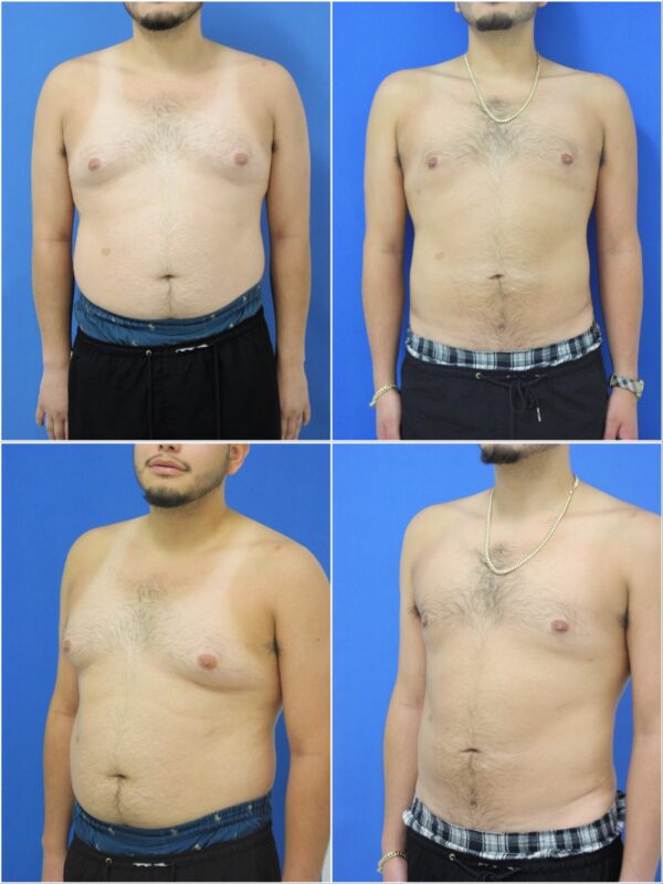 Before and After Image: Gynecomastia Correction - other