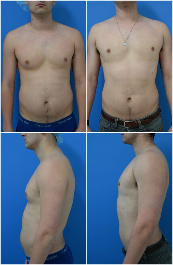 Before and After Image: Gynecomastia Correction - other