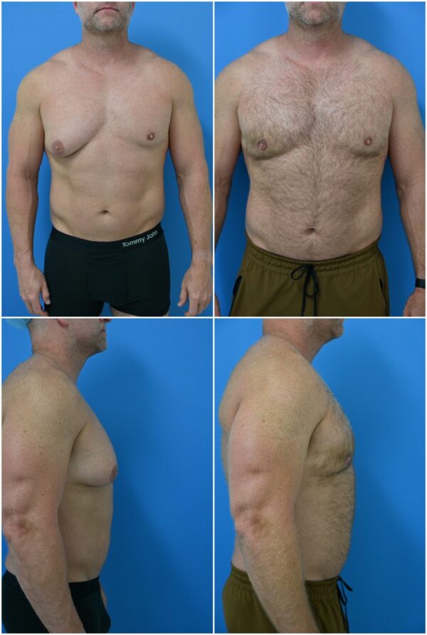 Before and After Image: Gynecomastia Correction - other