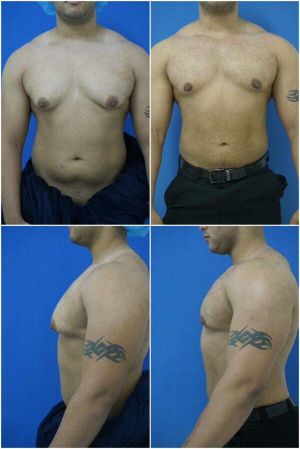 Before and After Image: Gynecomastia Correction - other