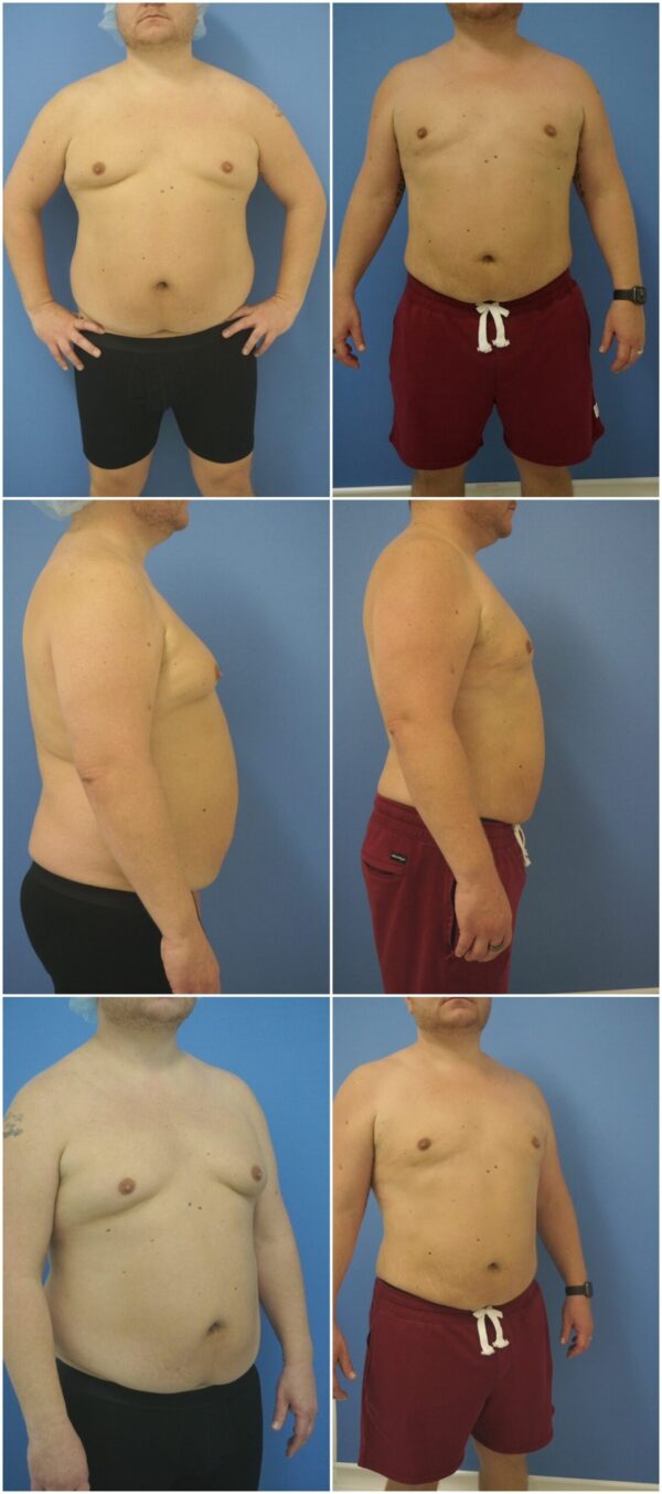 Before and After Image: Gynecomastia Correction - other