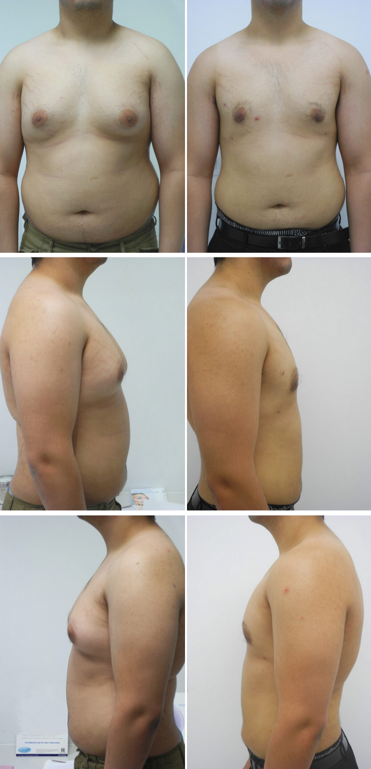 Before and After Image: Gynecomastia (Male Breast Reduction) - other