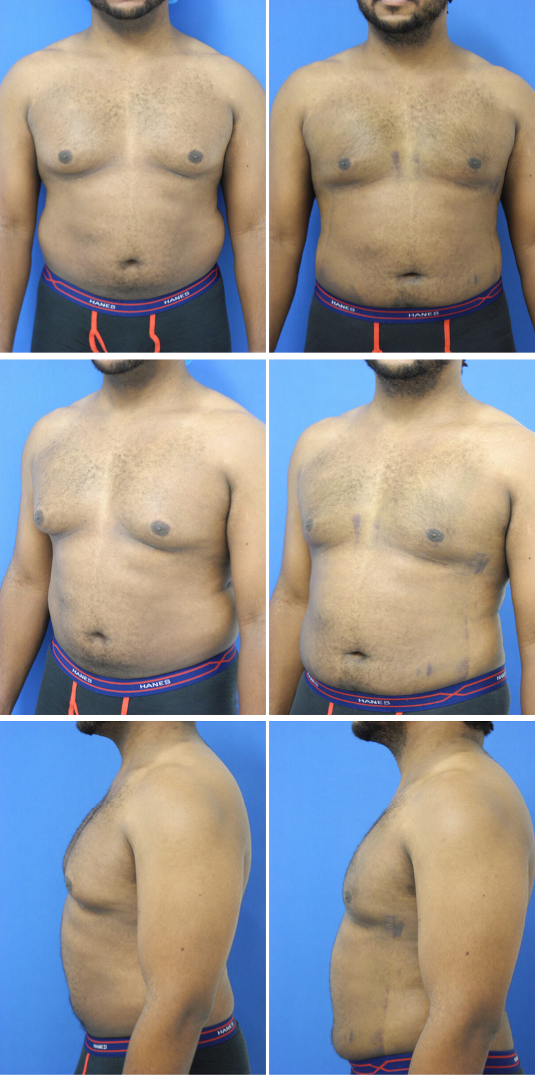 Before and After Image: Gynecomastia Correction - other