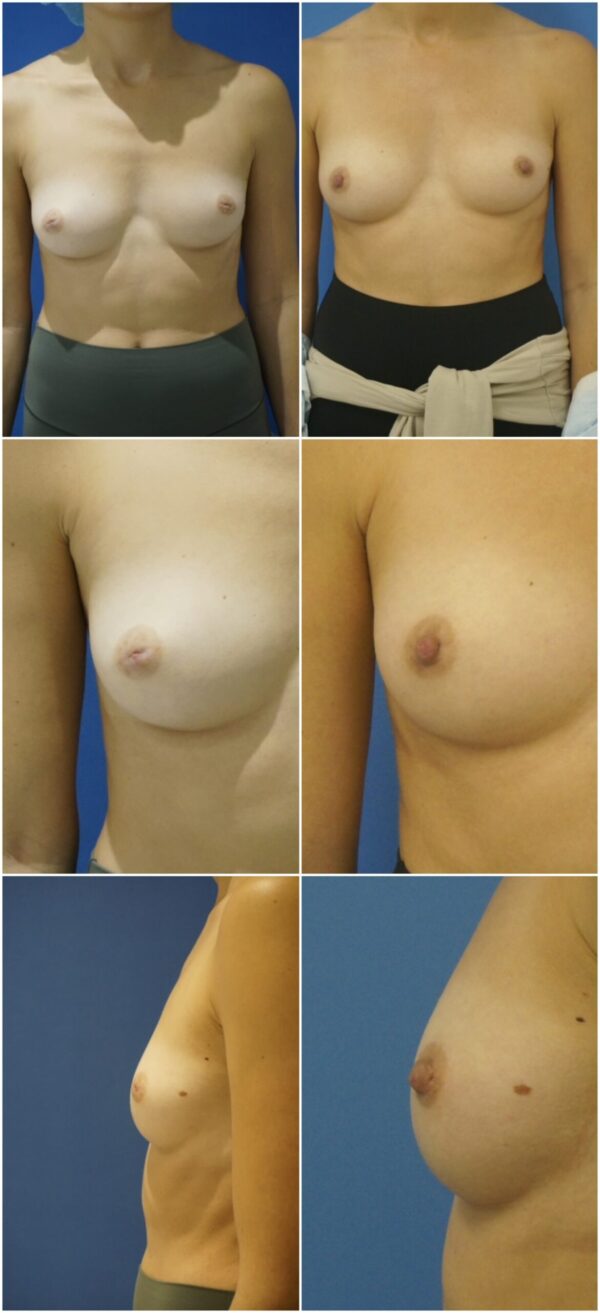 Before and After Image: Inverted Nipple Repair - other