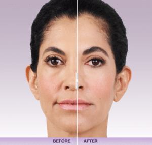Juverderm3 Dr. Gershenbaum 300x285 1 Dermal Facial Fillers in Miami, FL