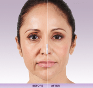 Juverderm4 Dr. Gershenbaum 300x285 1 Dermal Facial Fillers in Miami, FL