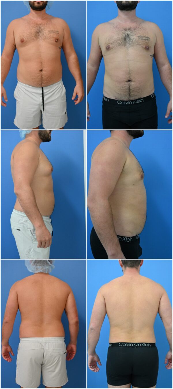 Before and After Image: Gynecomastia Correction - other