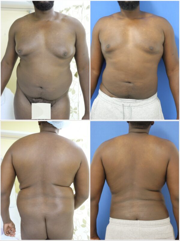 Before and After Image: Liposuction / Liposculpture Surgery - other
