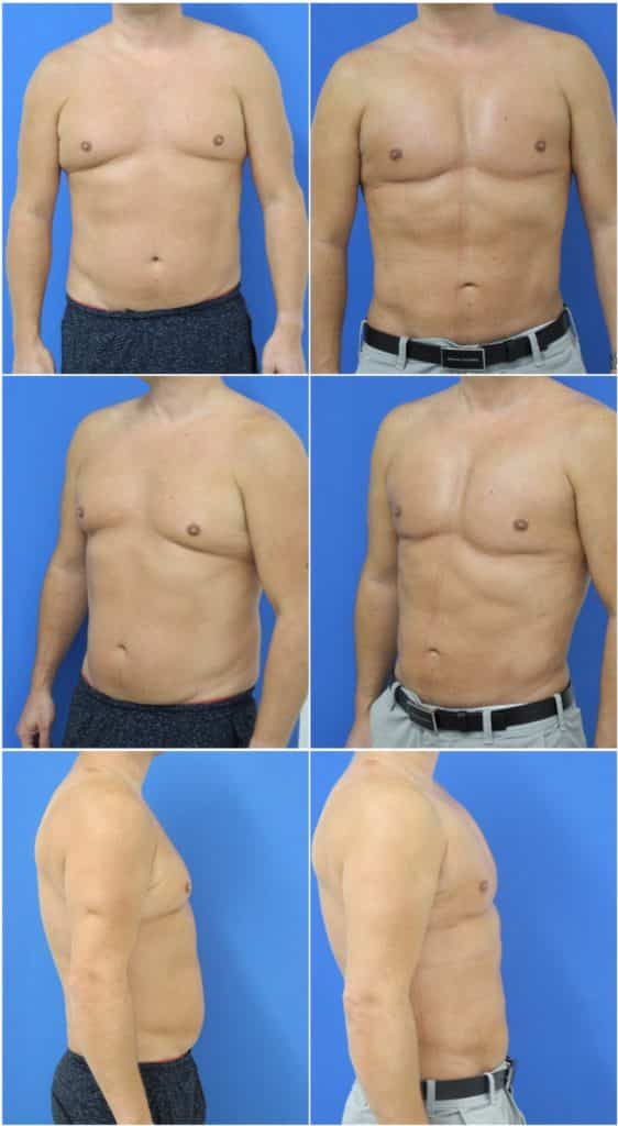 Before and After Image: Male Pec Implant - other