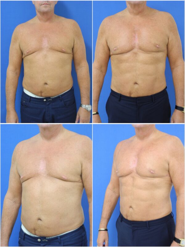 Before and After Image: Liposuction / Liposculpture Surgery - other