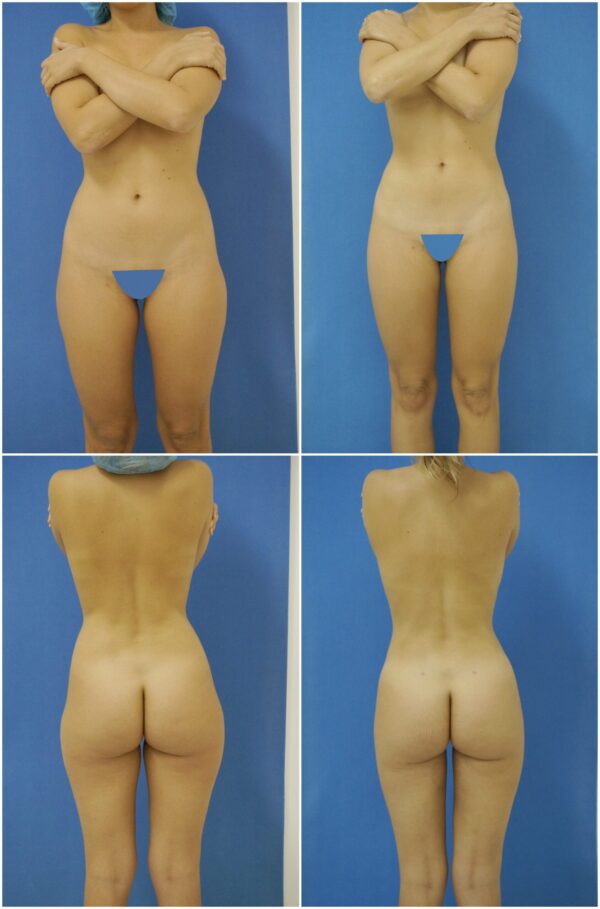 Before and After Image: Liposuction / Liposculpture Surgery - other