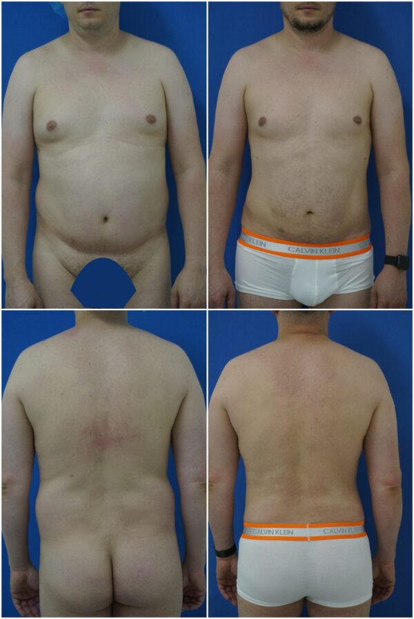 Before and After Image: Liposuction / Liposculpture Surgery - other