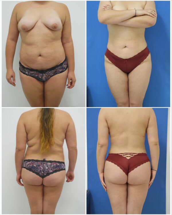 Before and After Image: Liposuction / Liposculpture Surgery - other