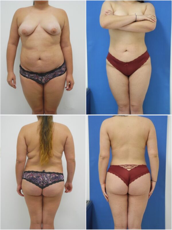 Before and After Image: Liposuction / Liposculpture Surgery - other