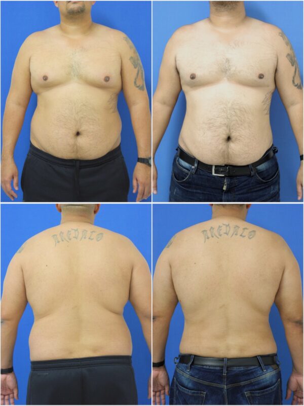 Before and After Image: Liposuction / Liposculpture Surgery - other
