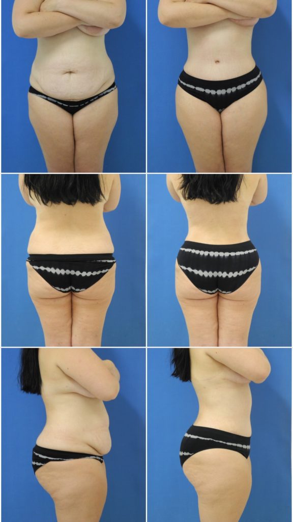 Before and After Image: Liposuction / Liposculpture Surgery - other