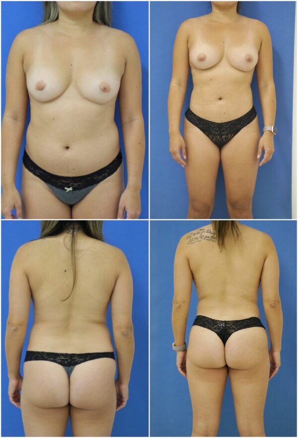 Before and After Image: Liposuction / Liposculpture Surgery - other