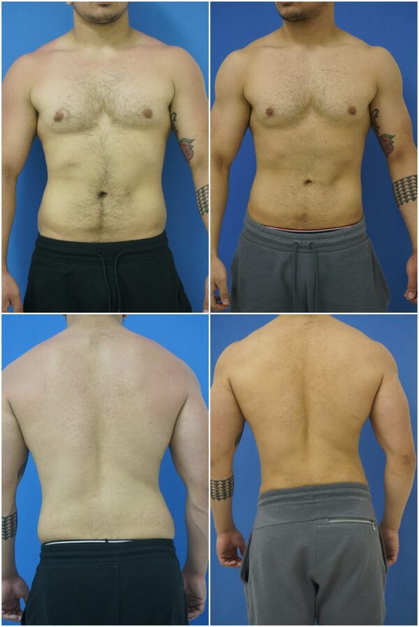 Before and After Image: Liposuction / Liposculpture Surgery - other