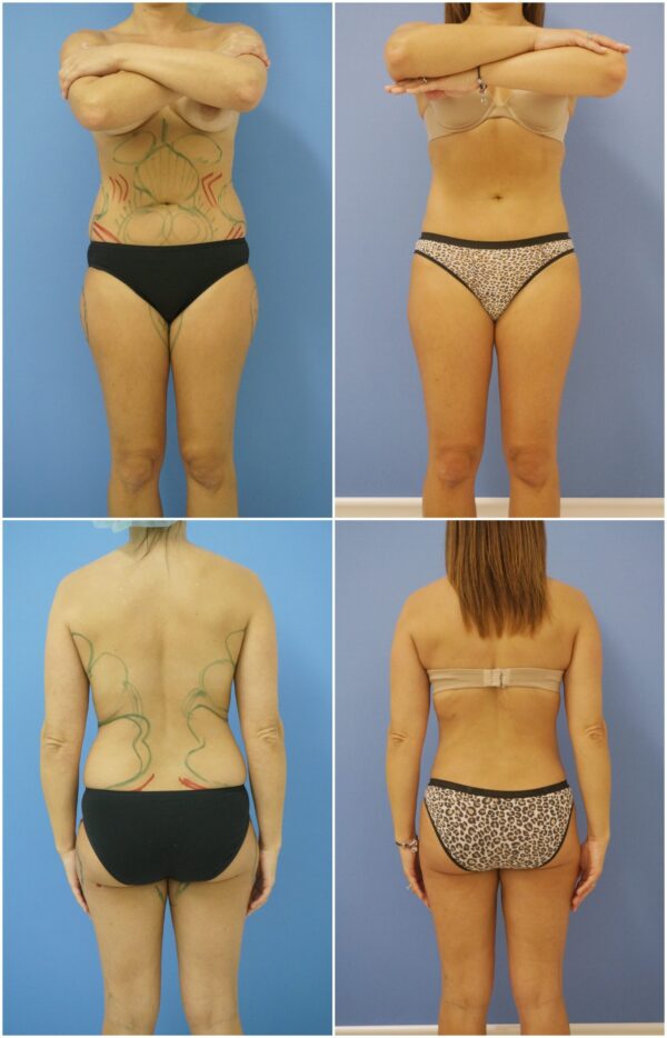 Before and After Image: Liposuction / Liposculpture Surgery - other