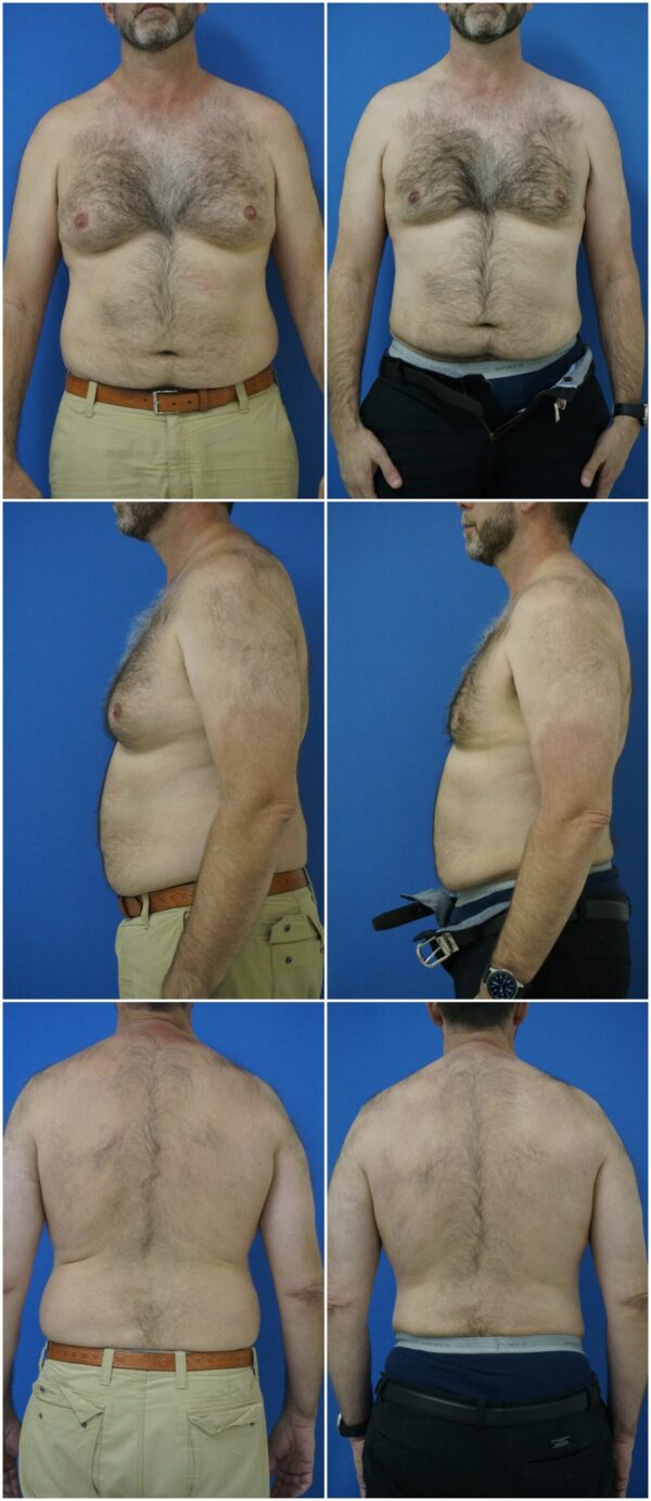 Before and After Image: Liposuction / Liposculpture Surgery - other
