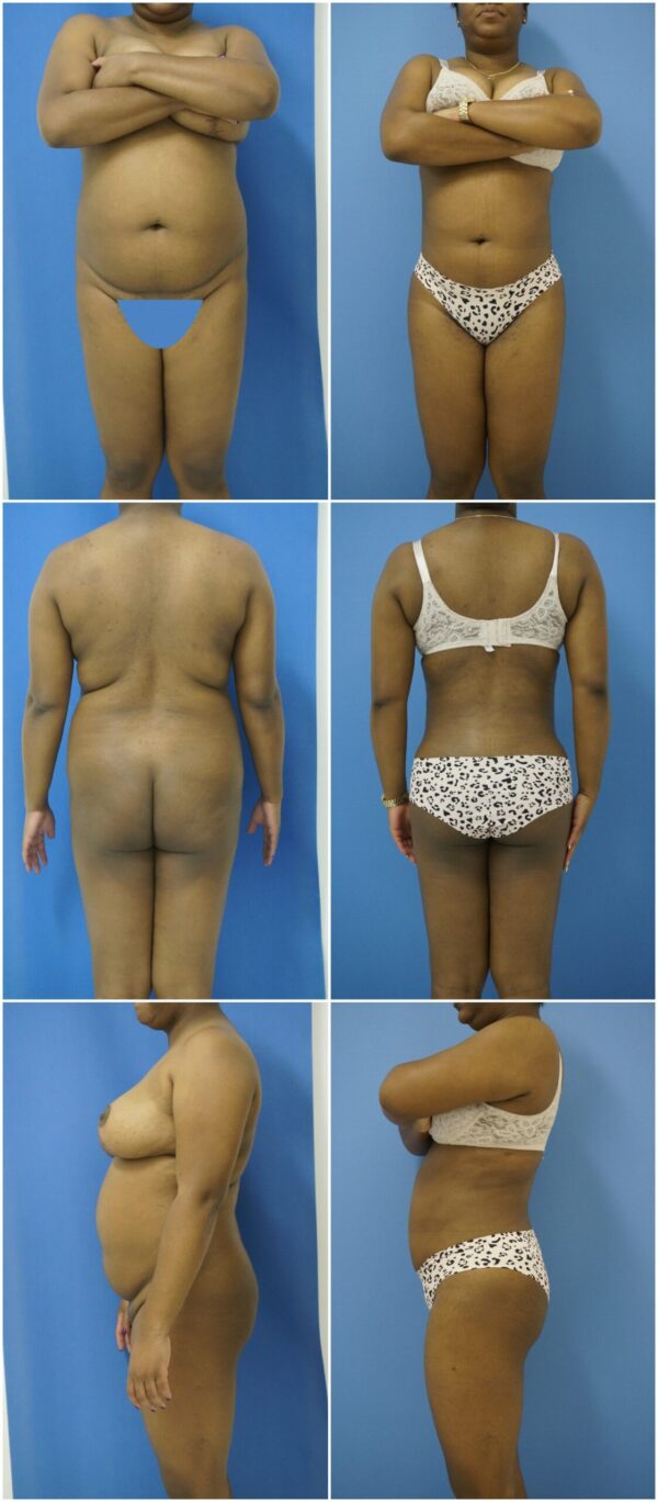 Before and After Image: Liposuction / Liposculpture Surgery - other