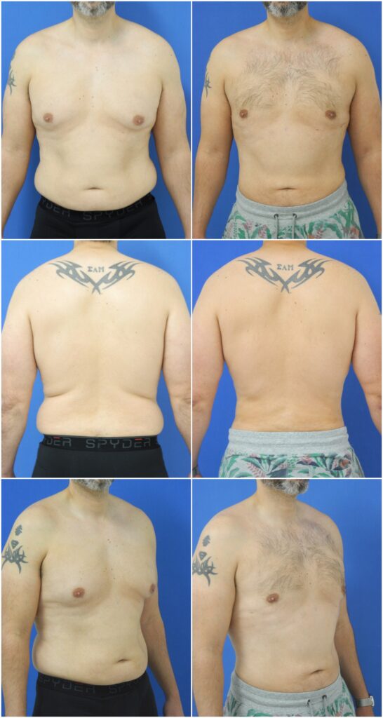 Before and After Image: Liposuction / Liposculpture Surgery - other