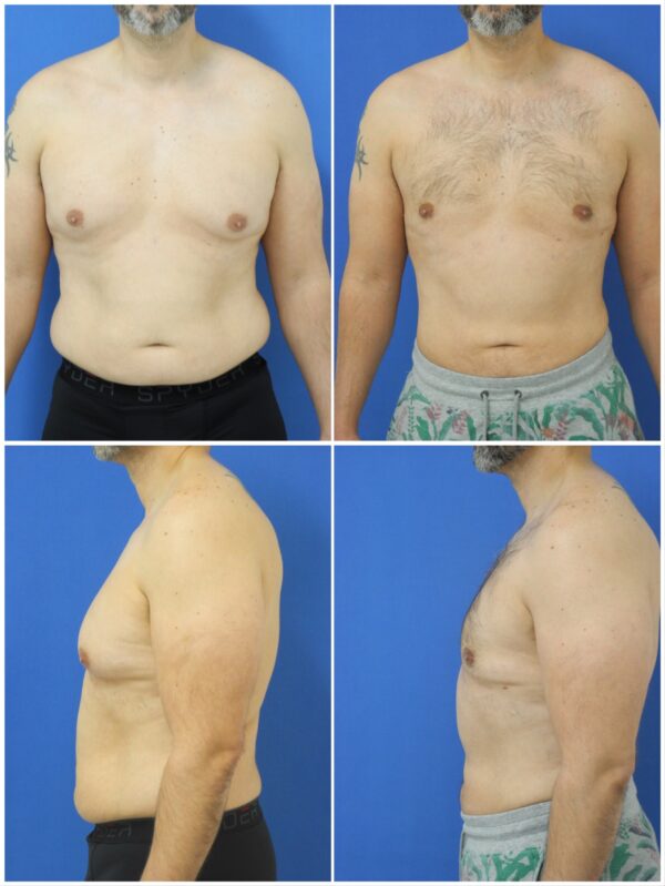 Before and After Image: Gynecomastia Correction - other