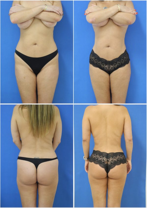 Before and After Image: Liposuction / Liposculpture Surgery - other