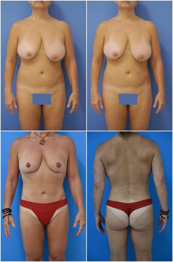 Before and After Image: Liposuction / Liposculpture Surgery - other