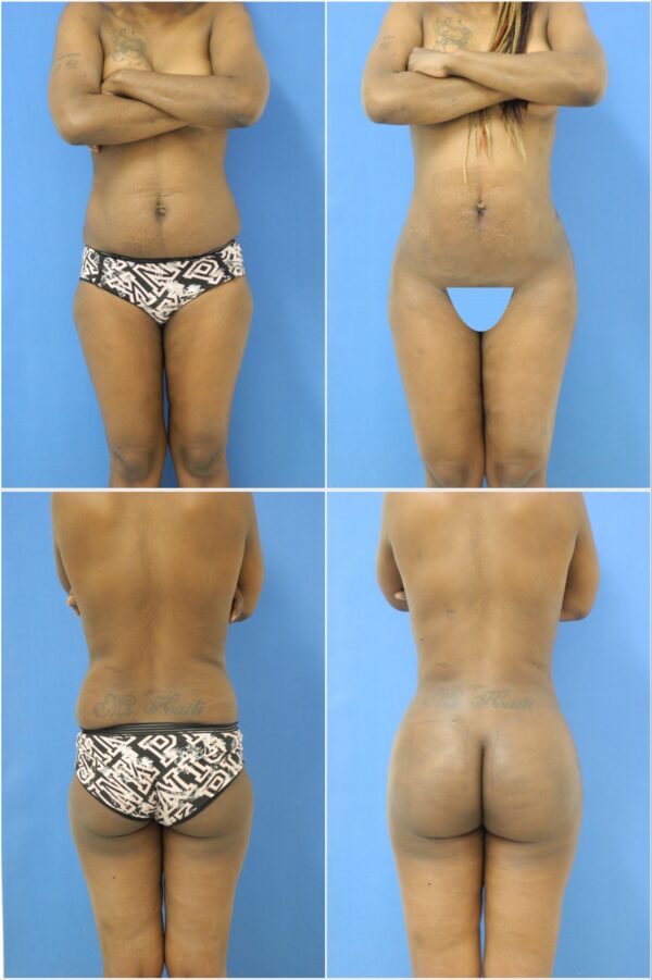 Before and After Image: Liposuction / Liposculpture Surgery - other