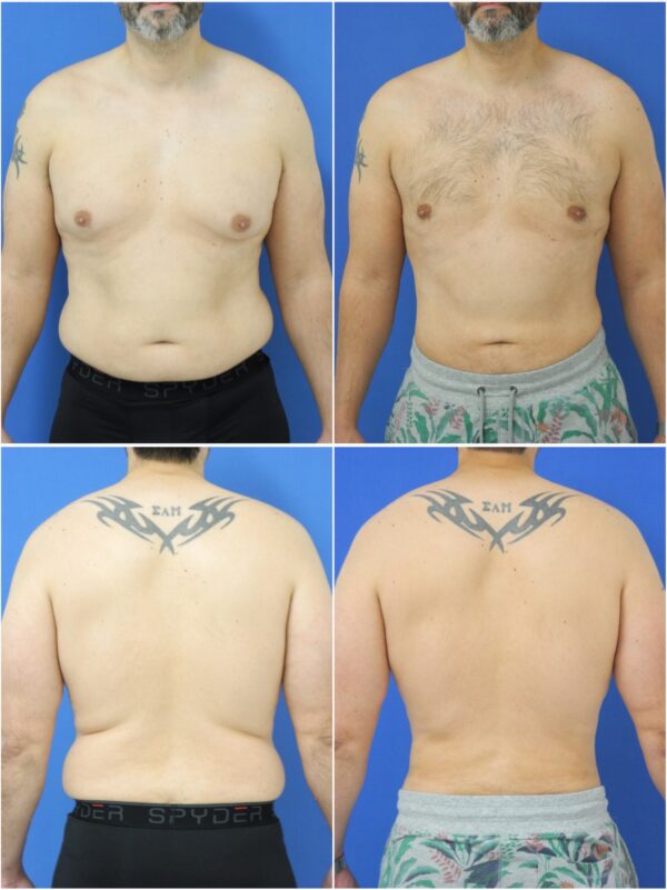 Before and After Image: Liposuction / Liposculpture Surgery - other