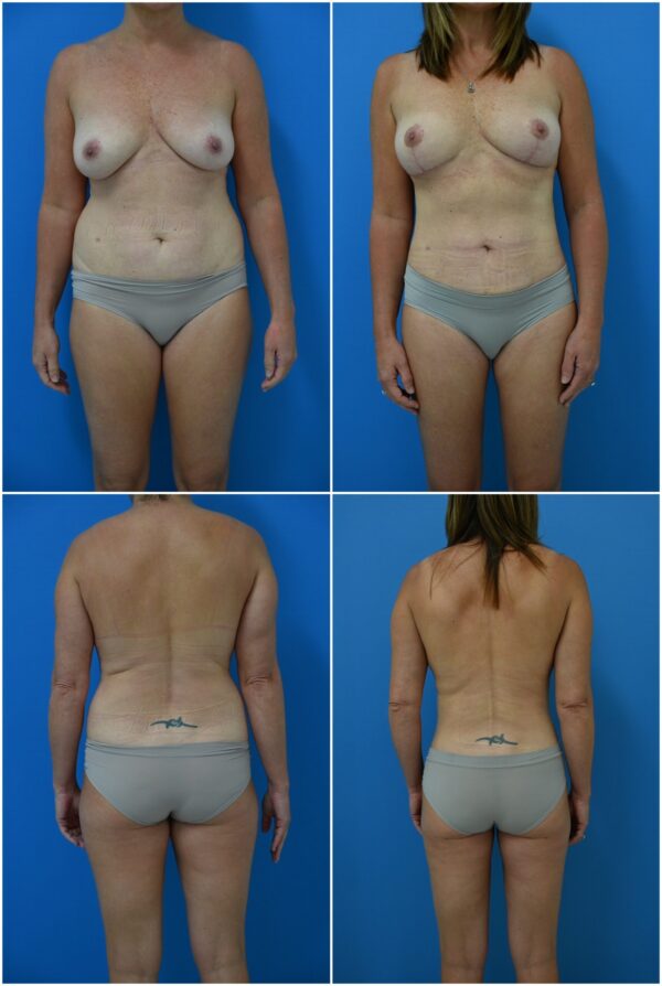 Before and After Image: Liposuction / Liposculpture Surgery - other