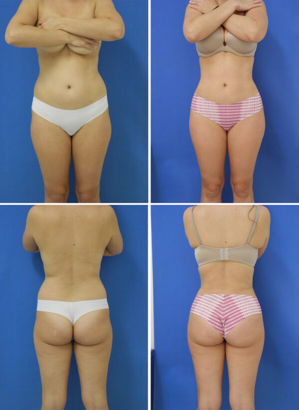 Before and After Image: Liposuction / Liposculpture Surgery - other