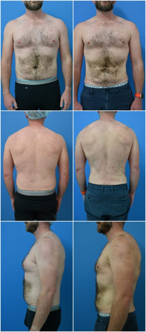 Before and After Image: Liposuction / Liposculpture Surgery - other