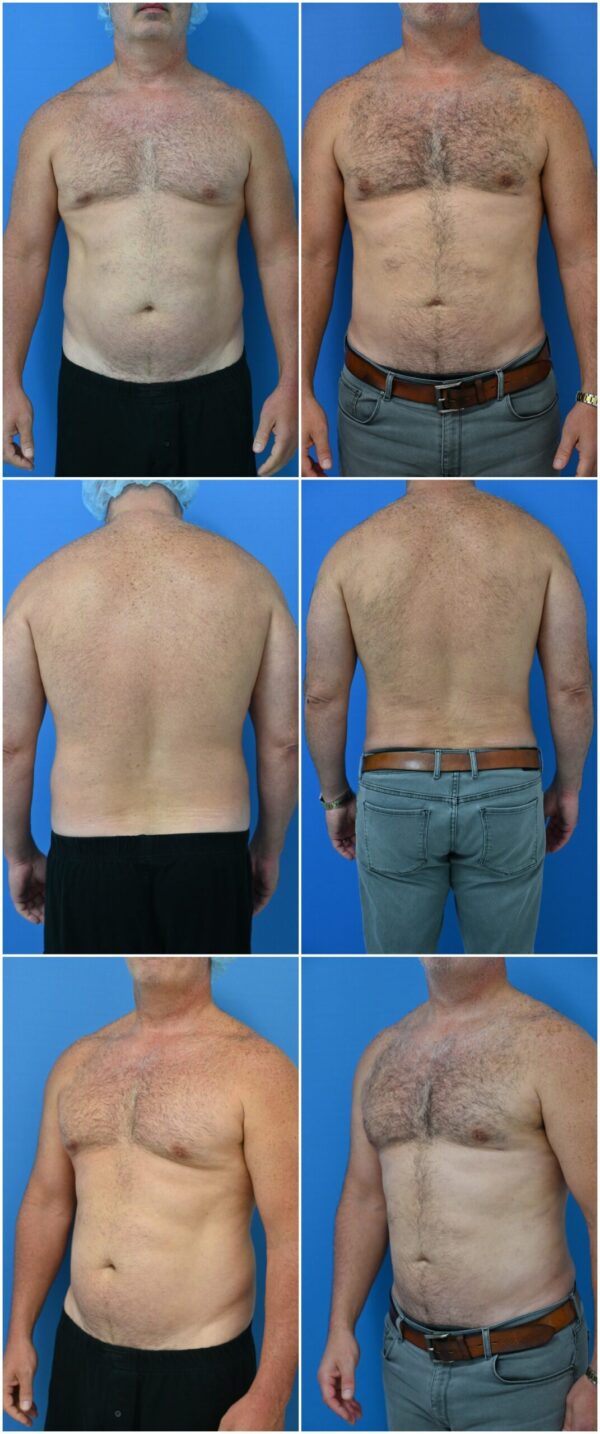 Before and After Image: Gynecomastia Correction - other