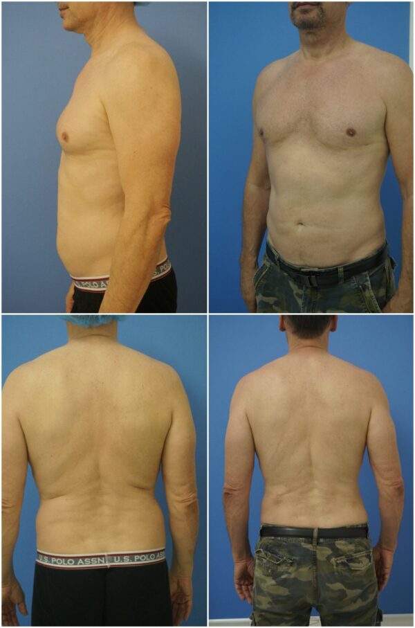 Before and After Image: Gynecomastia Correction - other