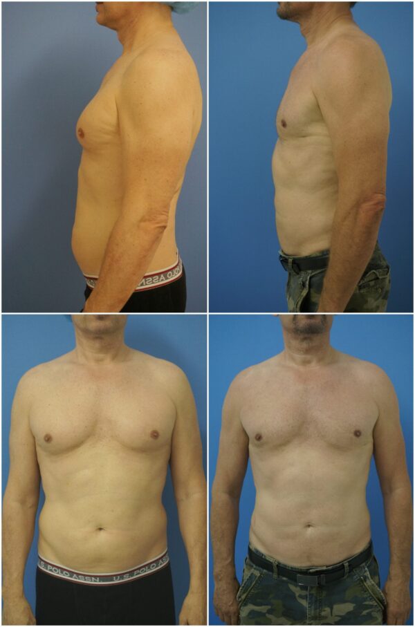Before and After Image: Gynecomastia Correction - other