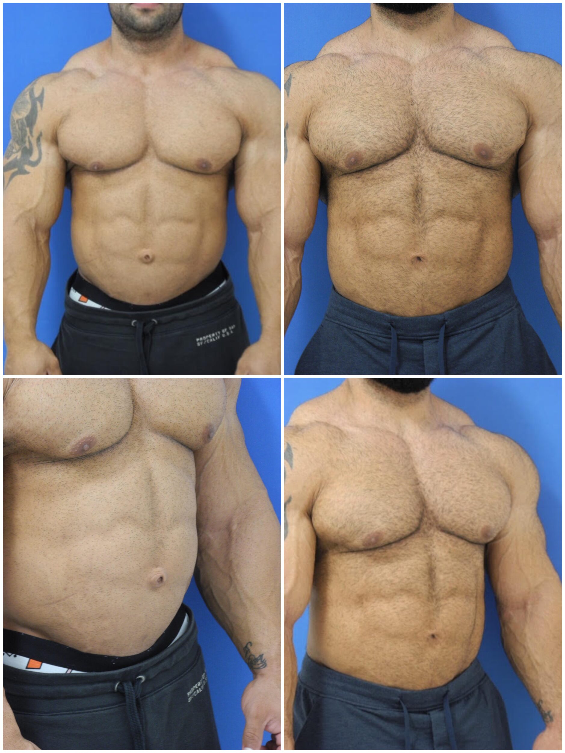 Before and After Image: Gynecomastia Correction - other