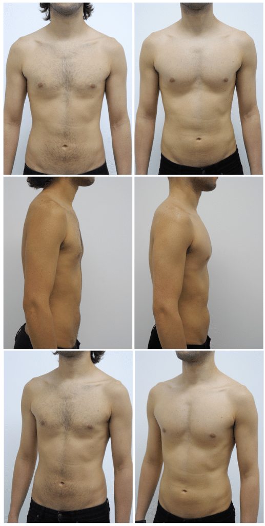 Before and After Image: Male Pec Implant - other