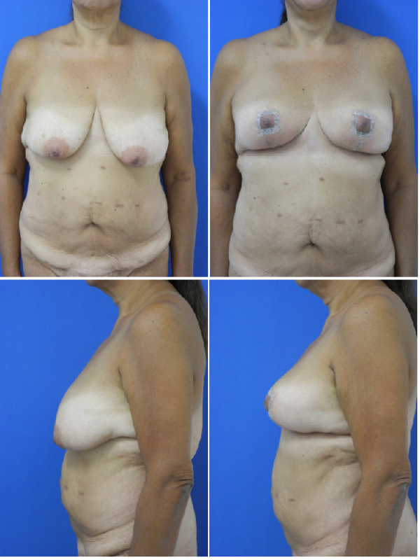 Before and After Image: Breast Lift - other