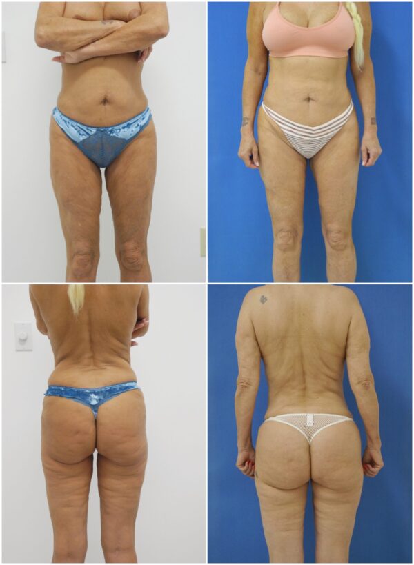 Before and After Image: Thigh Lift - other