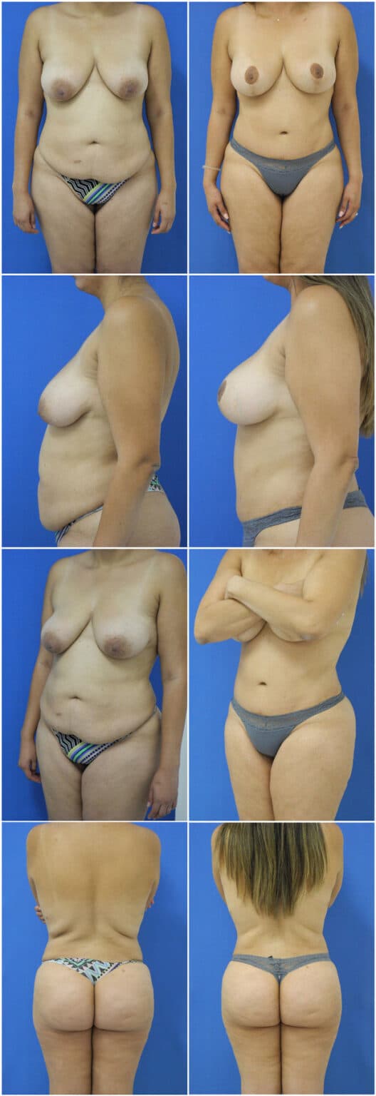 Before and After Image: Tummy Tuck (Abdominoplasty) - other