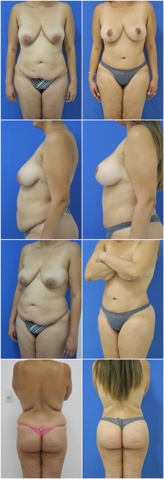 Before and After Image: Breast Lift - other