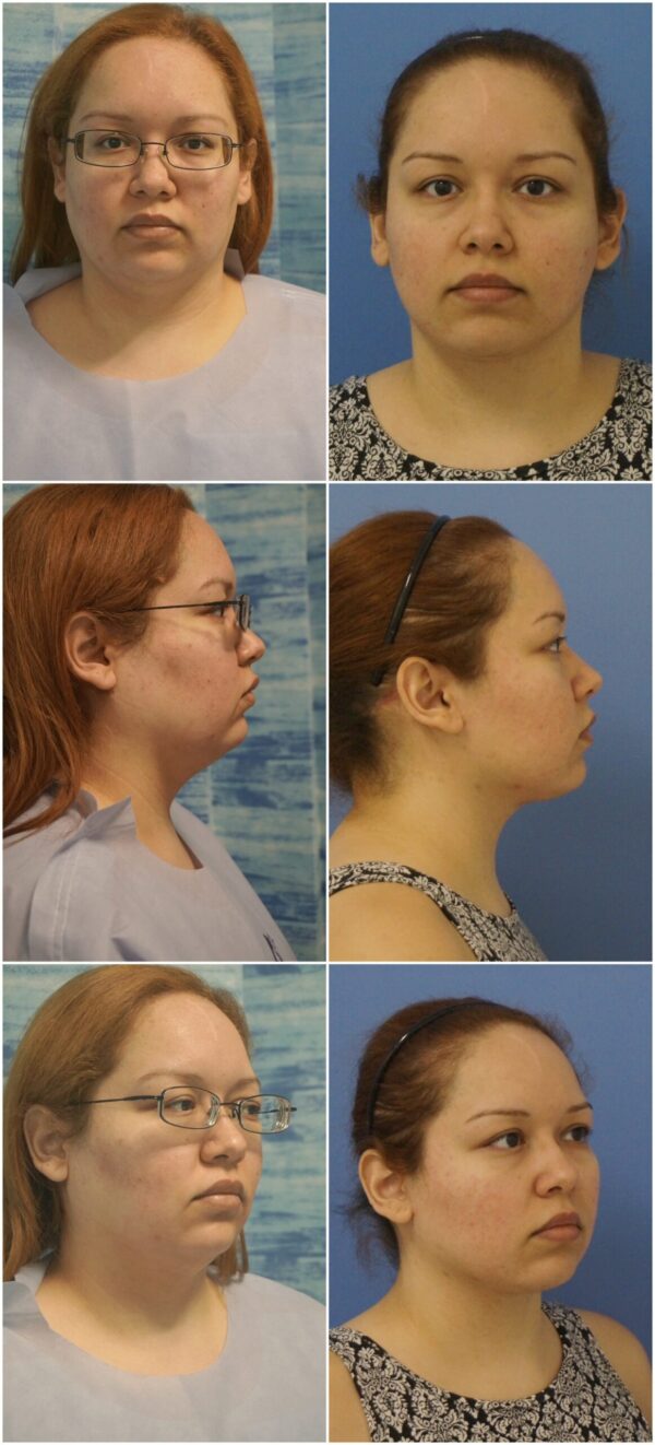 Before and After Image: Neck Lift Surgery - other