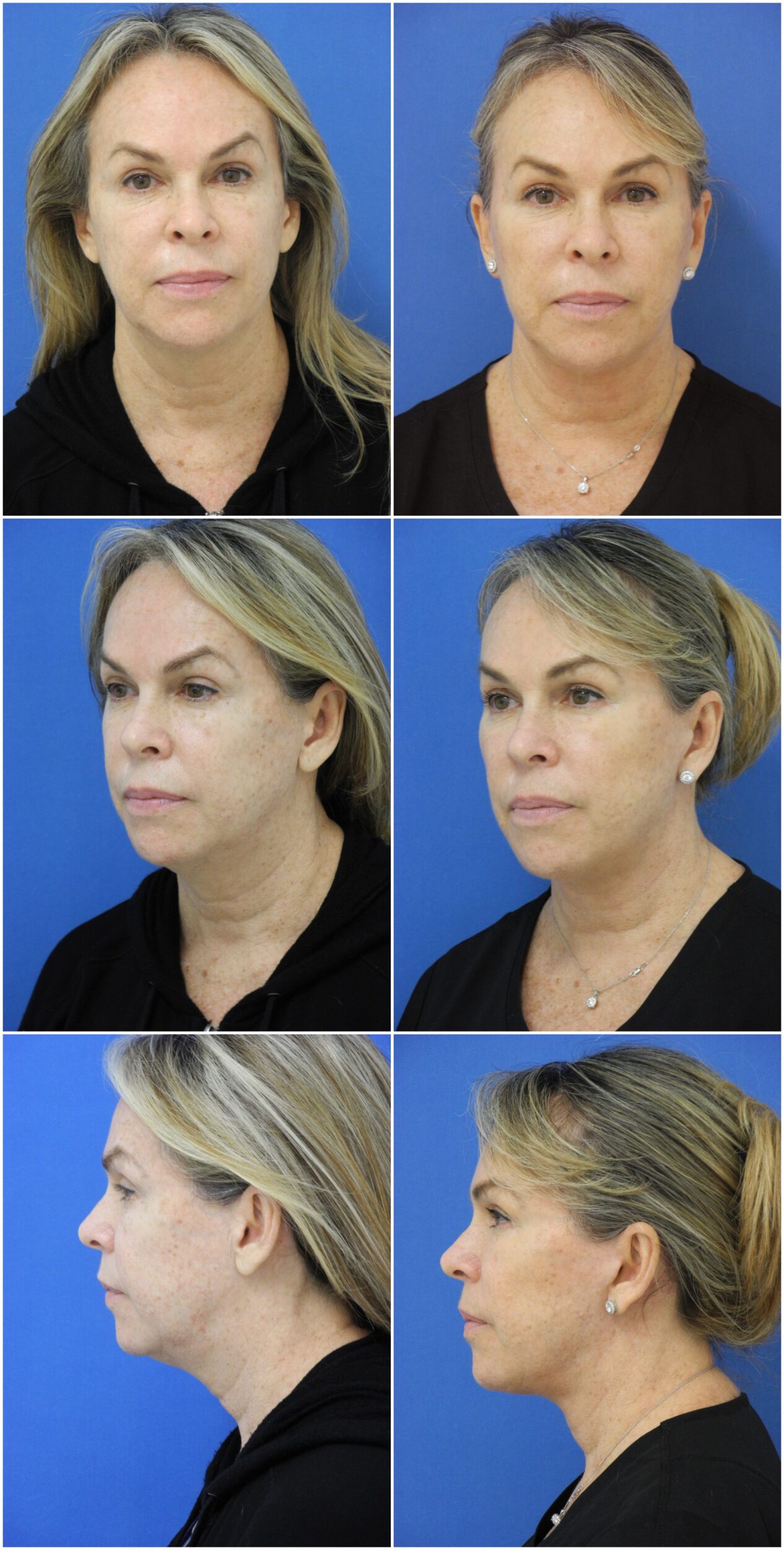 Before and After Image: Facelift Surgery - other